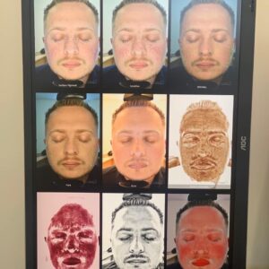 3d visage face skin care analysis 