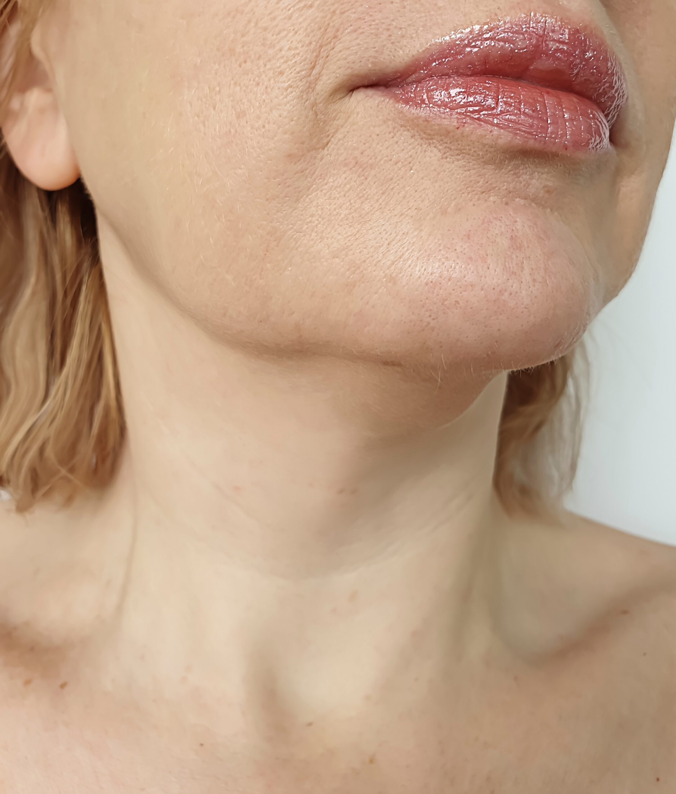 jaw reduction before