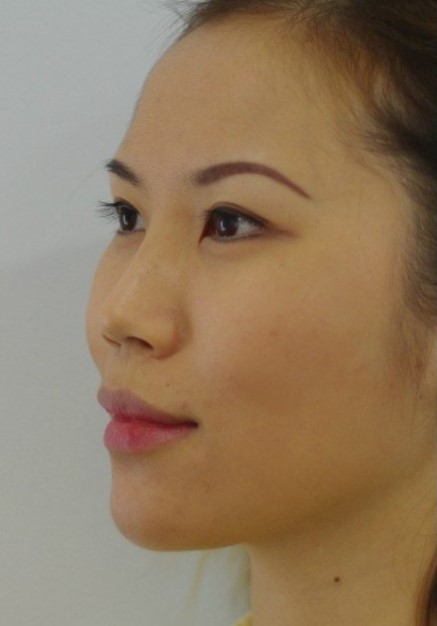 Chin & Jaw Filler after