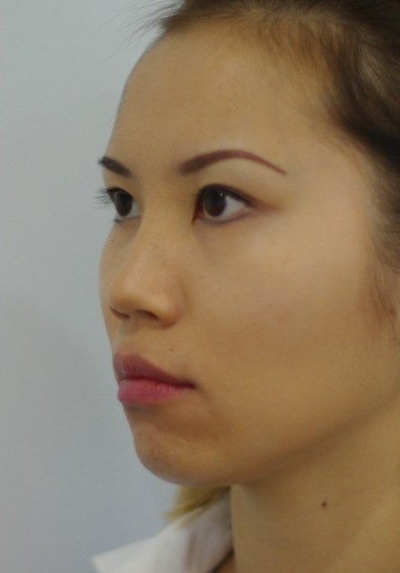 Chin & Jaw Filler before