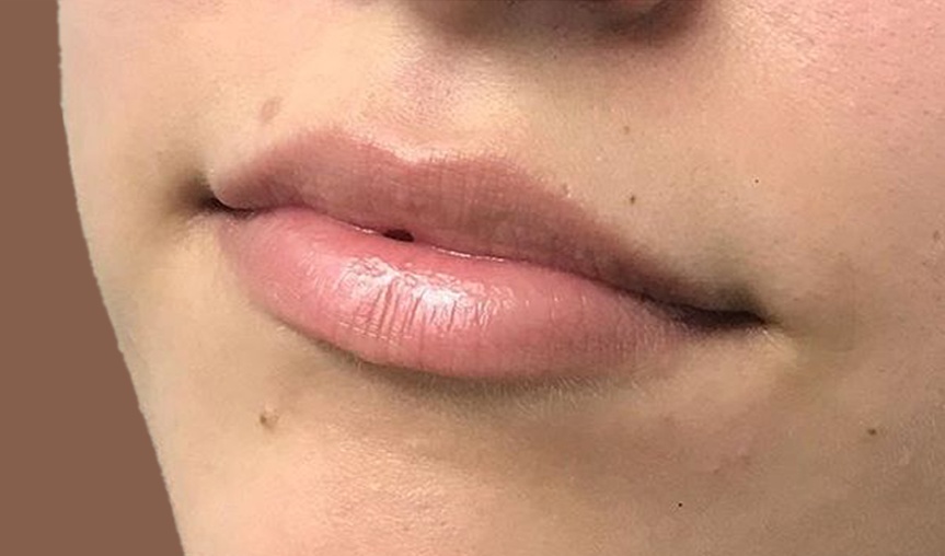 Lip Enhancement before