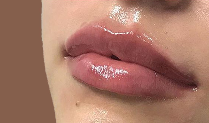 Lip Enhancement after