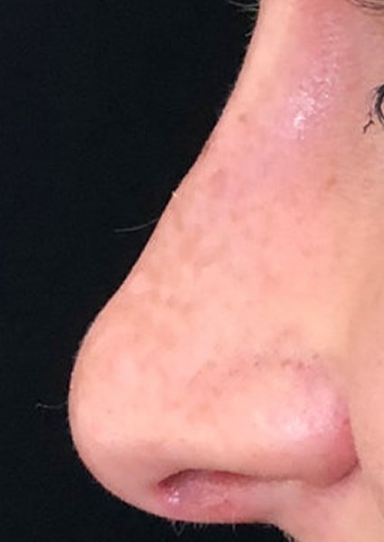 Nose Reshaping after