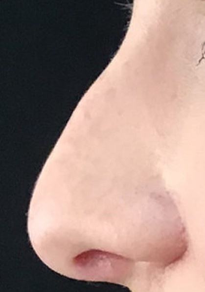 Nose Reshaping before