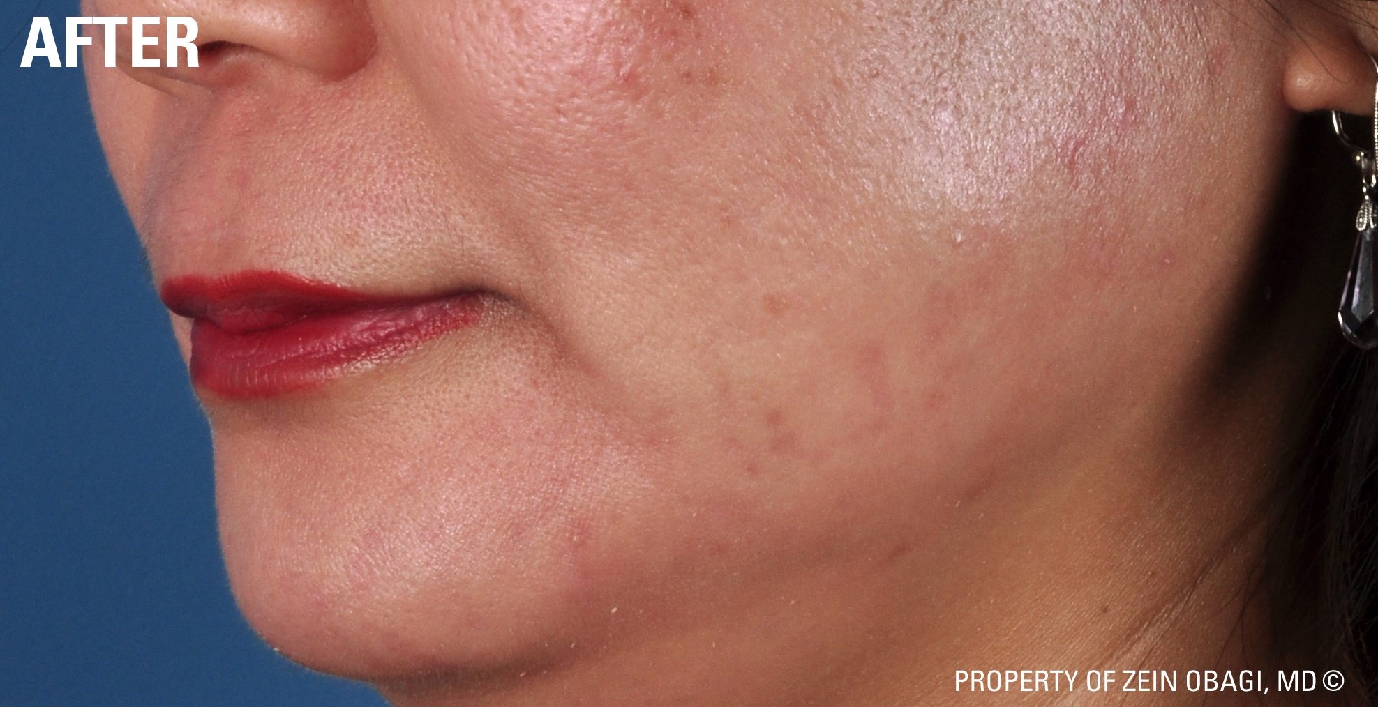 Obagi Skin Care after