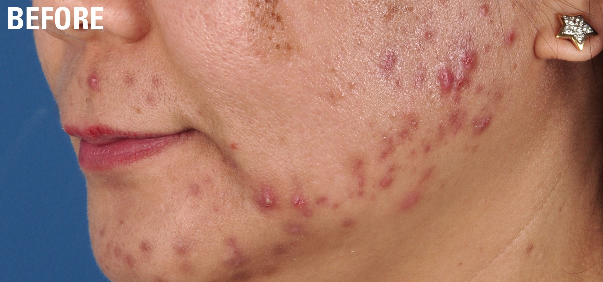 Obagi Skin Care before