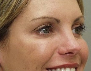under-Eye Filler after