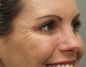 under-Eye Filler before